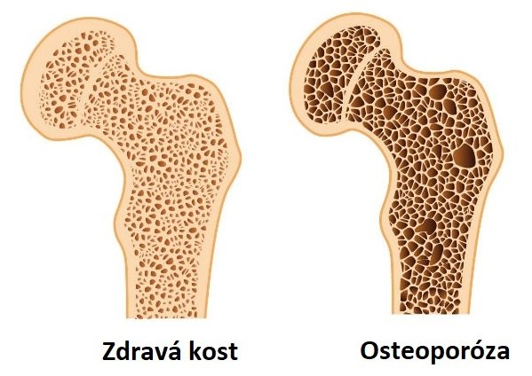 Porovnání zdravé kosti a kosti postižené osteoporózou.
