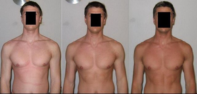 melanotan postup opálenia