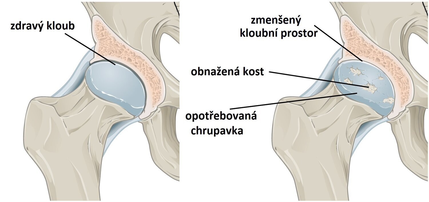 Ukázka osteoartritídy