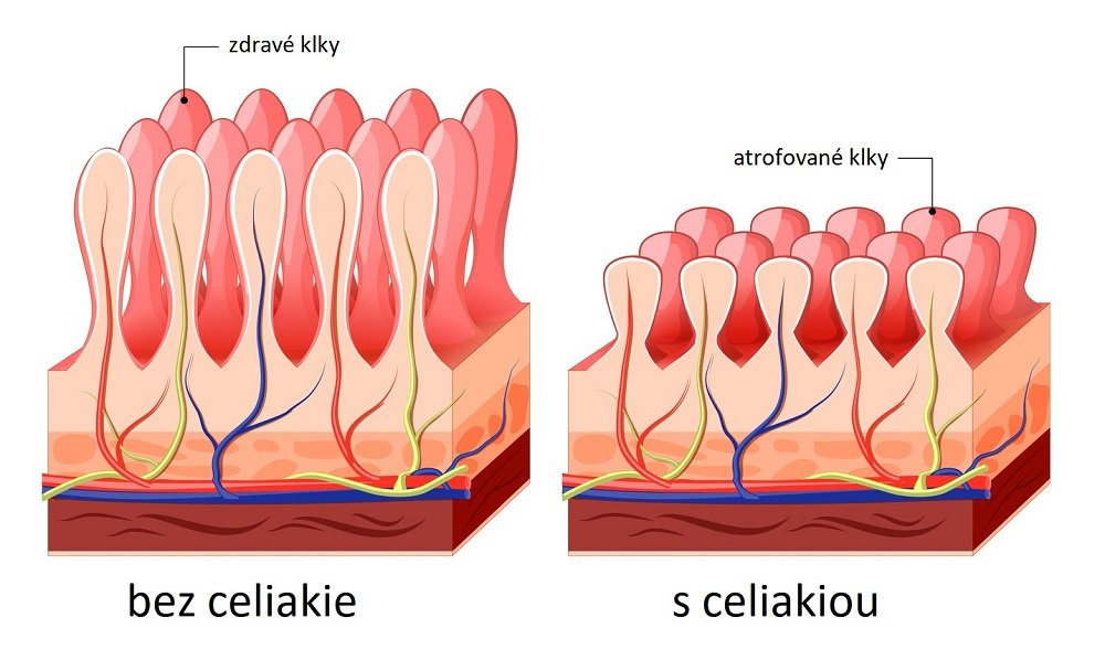 Celiakia.